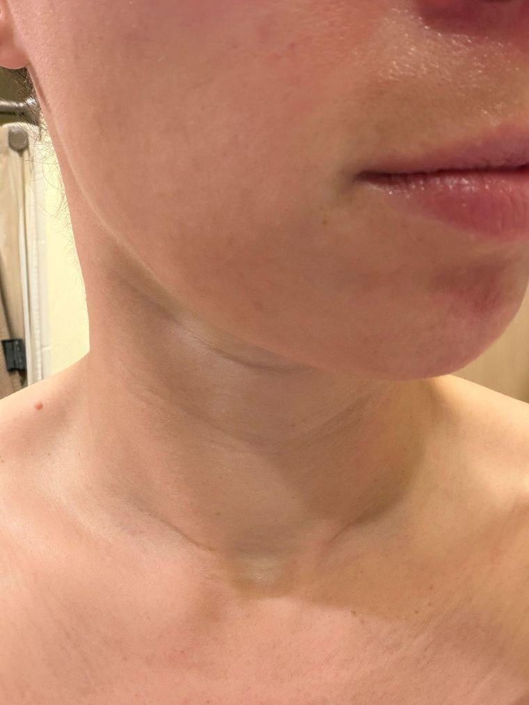 Postpartum Skin, Blemishes, and Two Scars