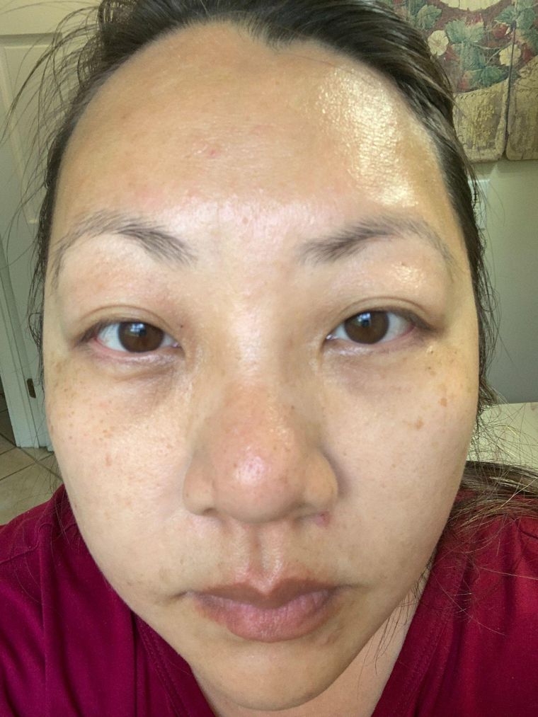 Fifteen Years of Eczema and Hormonal Acne