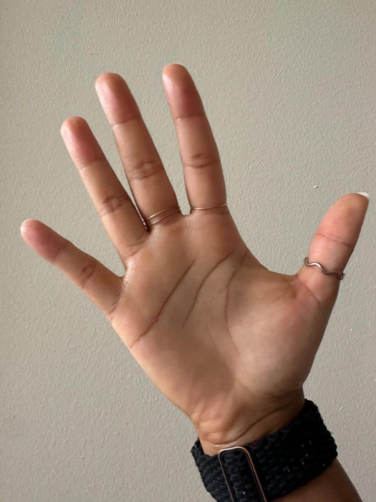 Adult Acne, and Hands She Hid
